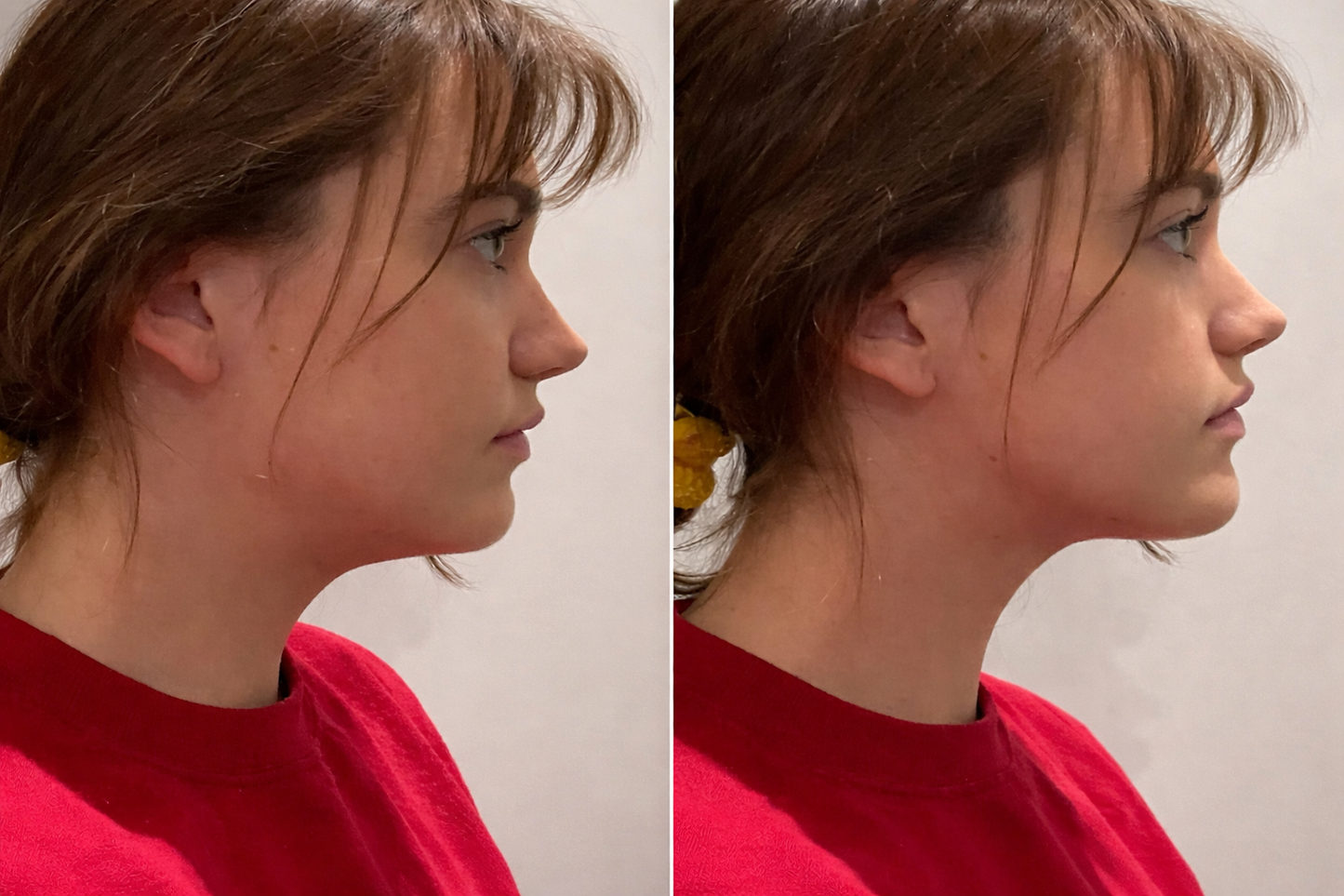 Limfatikus nyirok kefe